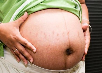 Mencegah Stretch Marks Selama Kehamilan