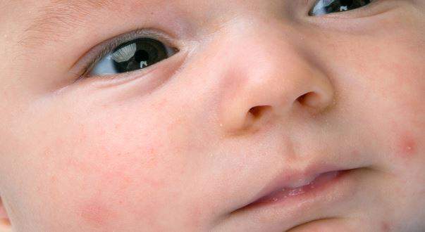 Mengobati dan Menghilangkan Bekas Gigitan Nyamuk Pada Bayi